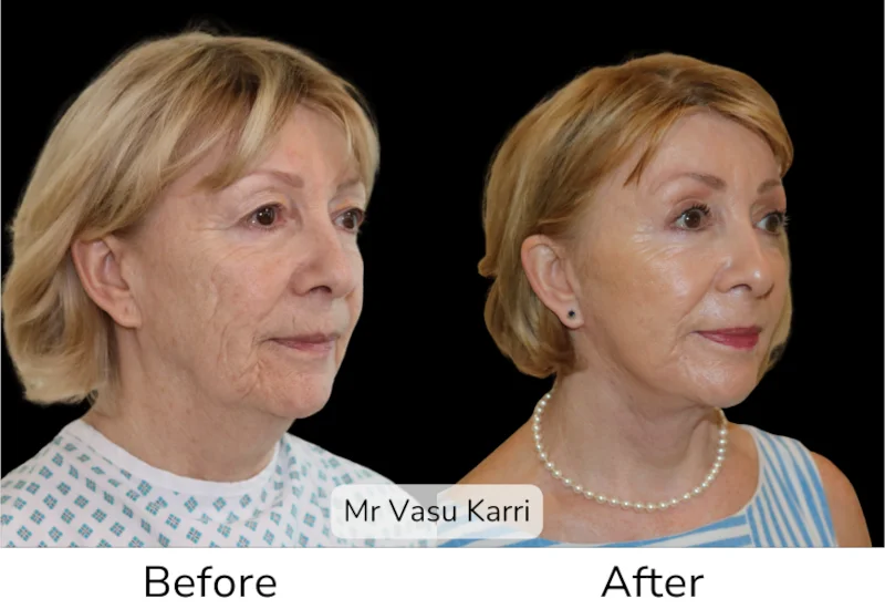Facelift Patient 8 View 2